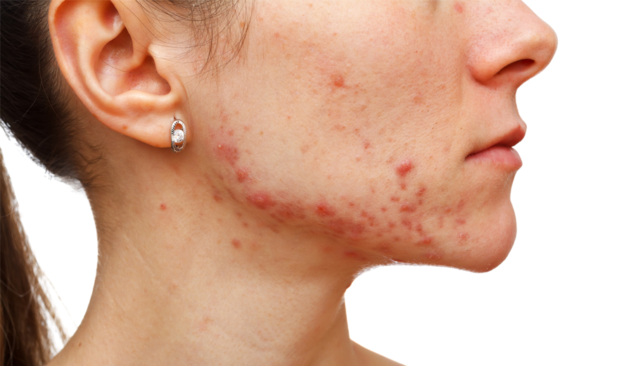 mei ten tweede Belastingen Tiener acne » Het Huidinstituut